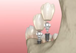 dental implants 