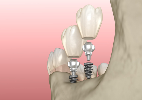 dental implants