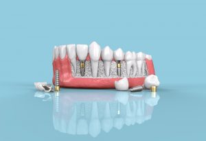 3D illustration of dental implants and prosthetic teeth, showcasing a dental arch with titanium posts, emphasizing the process of tooth restoration and the benefits of dental implants.